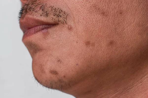 Pequenos Manchas Marrons Chamados Pontos Idade Cicatrizes Rosto Homem Asiático — Fotografia de Stock