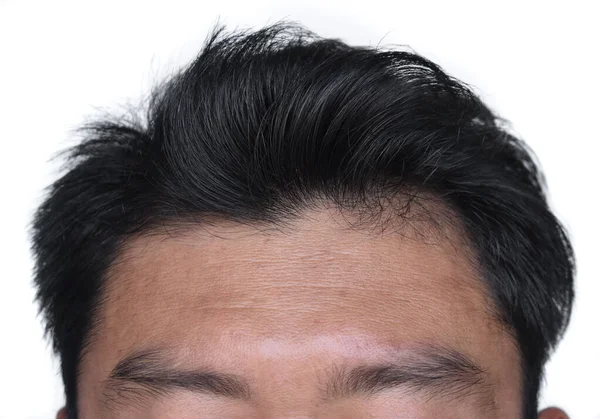 Thinning Sparse Hair Male Pattern Hair Loss Wrinkles Folds Forehead — Stock Photo, Image
