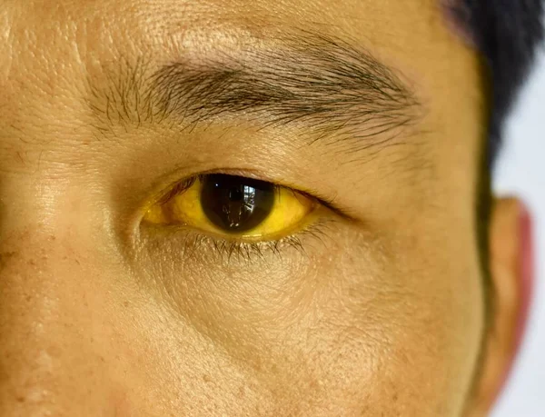 Deep Jaundice Asian Male Patient Yellowish Discoloration Skin Sclera Hyperbilirubinemia — Stockfoto