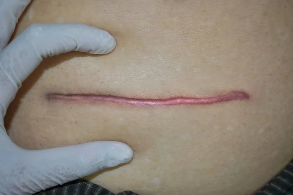 Neat Tidy Clean Hypertrophic Scar Straight Surgical Incision Top View — Fotografia de Stock