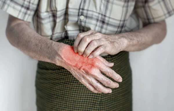 Homem Mais Velho Asiático Coçar Mão Conceito Doenças Pele Com — Fotografia de Stock