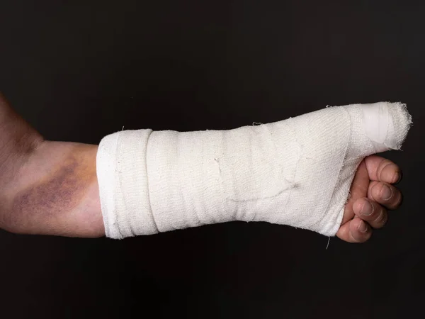 手を石膏で 手に大きな打撲 男の写真を切り取った 手術後 関節置換 プレレール — ストック写真