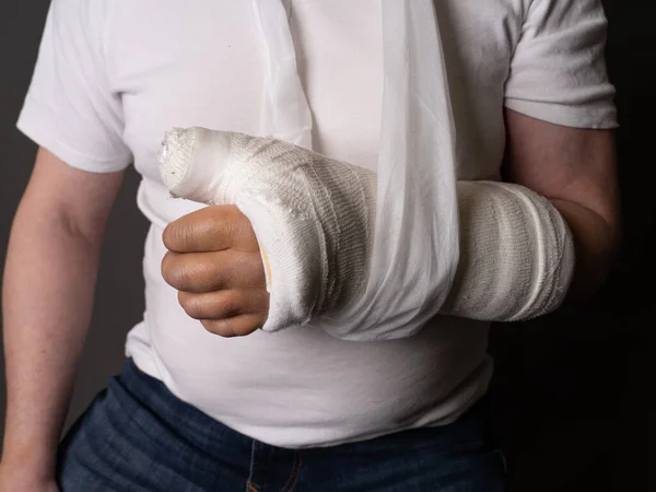 手を石膏で 手に大きな打撲 男の写真を切り取った 手術後 関節置換 プレレール — ストック写真