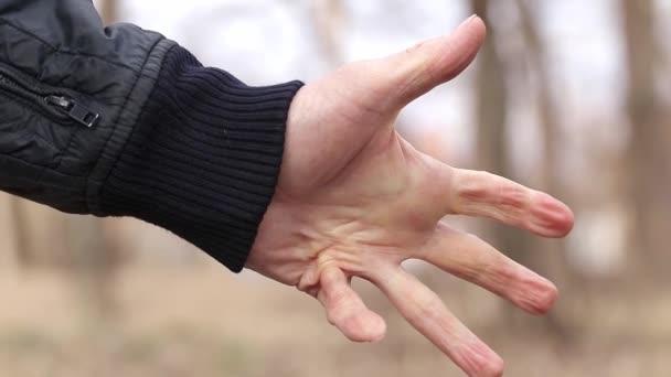 Пошкодження Сухожилля Руці Чоловіча Долоня Пошкодженим Сухожиллям Пальця Маленький Палець — стокове відео