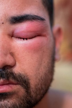 Arı sokmasından dolayı gözü şişmiş yetişkin bir adam.