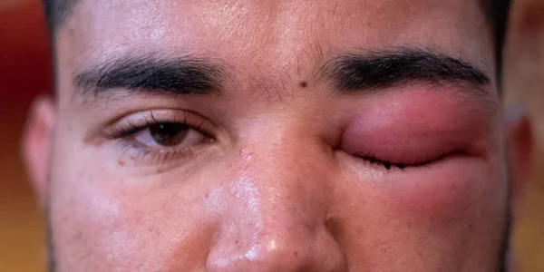 Adult man with swollen eye from a bee sting