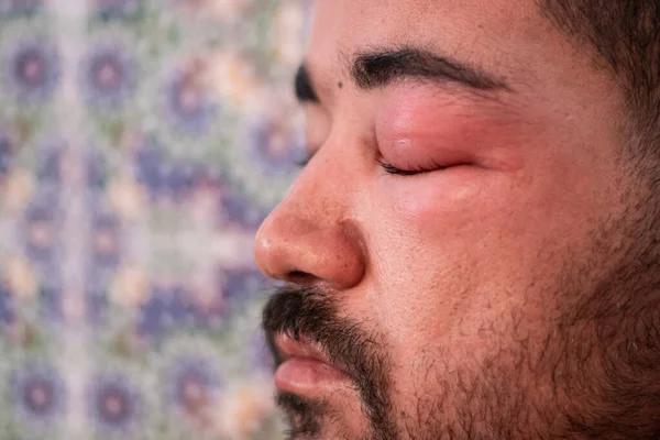 Erwachsener Mann Mit Geschwollenem Auge Nach Bienenstich — Stockfoto