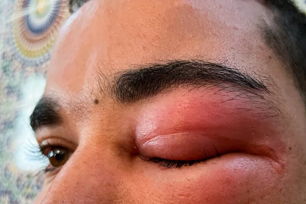 stock image Adult man with swollen eye from a bee sting