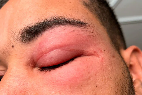 Adult man with swollen eye from a bee sting