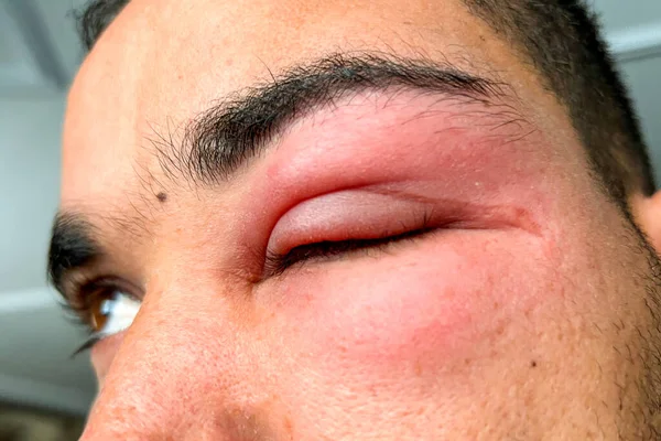 Erwachsener Mann Mit Geschwollenem Auge Nach Bienenstich — Stockfoto