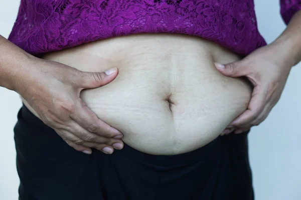 Closeup woman hands touch big belly, fat with cellulite abdomen. Concept, obesity. Overweight. Body shape problem for woman after pregnancy or getting older. Heath care.