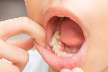 Kalabalık dişler. Malocclusion dişleri. Kalıcı dişleri olan bu çocuğun ağzına düşmemiş süt dişlerini yerleştir..