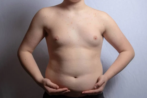 Ένας Υπέρβαρος Καυκάσιος Έφηβος Που Δείχνει Στομάχι Του Ενώ Στέκεται — Φωτογραφία Αρχείου