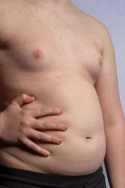 Adolescente Caucásico Con Sobrepeso Mostrando Estómago Mientras Está Pie —  Fotos de Stock