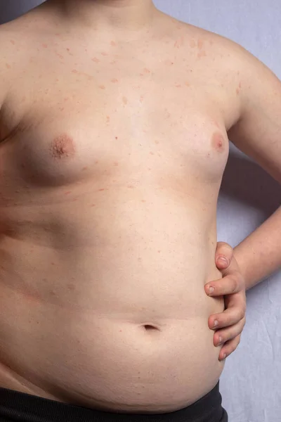 Adolescente Caucásico Con Sobrepeso Mostrando Estómago Mientras Está Pie —  Fotos de Stock