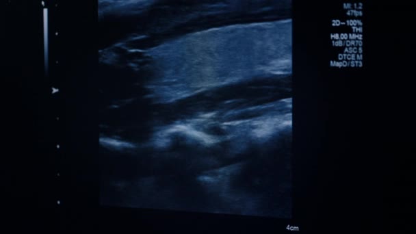 Exibição Imagem Ultra Som Monitor Sonografia Corpo Humano Triagem Ultrassonografia — Vídeo de Stock