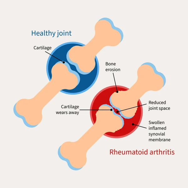 Reumatoïde Artritis Illustratie Auto Immuunziekte Inflammatoire Type Artritis — Stockvector