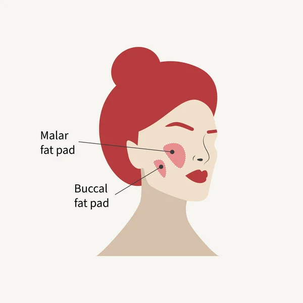 Eliminación Grasa Malar Grasa Bucal Antiaging Lifting Facial Con Cirugía — Archivo Imágenes Vectoriales