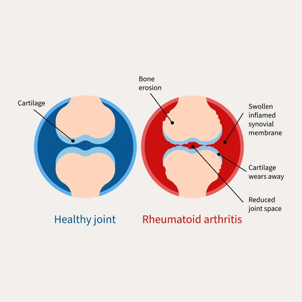 Reumatoïde Artritis Illustratie Auto Immuunziekte Inflammatoire Type Artritis — Stockvector