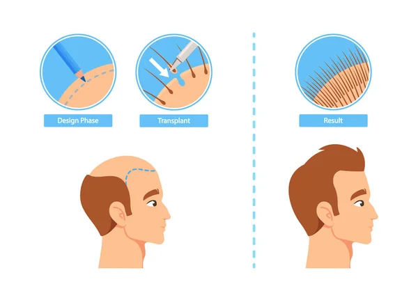 Hair Transplantation Process Infographics Including Design Phase Transplant Result Stages — Stock Vector