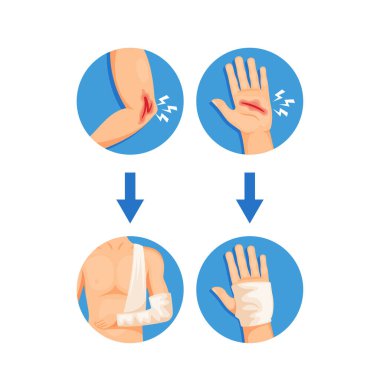 Process Of Injury Treatment and Bandaging, Infographics For Healthcare Or Medical-related Content. Hand With Wound Being Wrapped and Bandaged With White Bandage. Cartoon Vector Illustration
