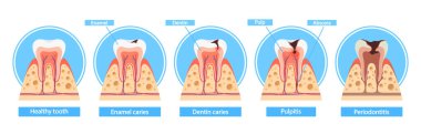 Caries Infographic 'in Aşamaları. Sağlıklı Diş, Enamel Caries, Dentin Caries, Pulpitis ve Periodontitis Cross Bölüm View. Tıbbi Görsel Bilgi, Eğitim Yardımı. Çizgi film Vektör İllüstrasyonu