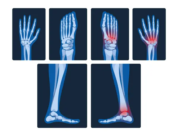 Ray Pictures Hands Legs Reveal Skeletal Structures Joint Health Potential — Stock Vector