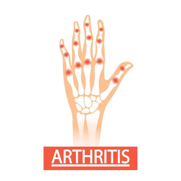 Human Hand Arthritis Medical Vector Illustration Swollen Distorted Hand Limited — Stock Vector