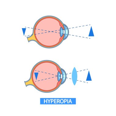 Hiperopya 'yı Bilgilendiren Vektör Bilgileri Düzeltici Merceklerle Normal ve Uzağı Gören Göz arasındaki farkı gözler önüne seriyor. Eğitimsel, tıbbi ve vizyonla ilgili amaçlar için kullanışlı