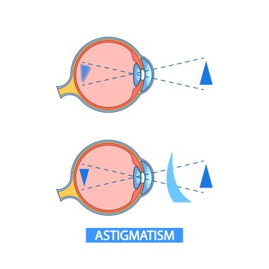 Detaylı Infographic Illustrating The Anatomy of a Eye with Astigmatism. Astigmatizmden etkilenen normal görme ve görme arasında eğitim ve tıbbi amaçlar için ideal bir karşılaştırma sağlar.