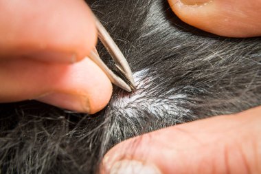 Tamamen emilmiş bir kene, Almanya 'da, cımbızla çıkartılır.