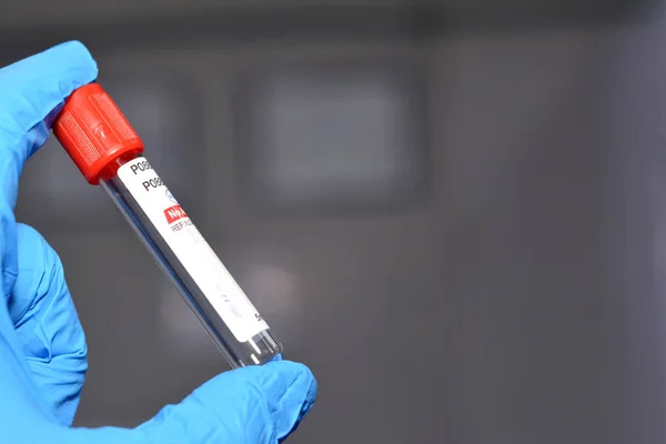 stock image Cairo, Egypt, October 22 2022: Blood collection tube for collecting blood samples for laboratory analysis tests like CBC complete blood count, ESR, CRP, FBS, HbA1C, kidney and liver function tests