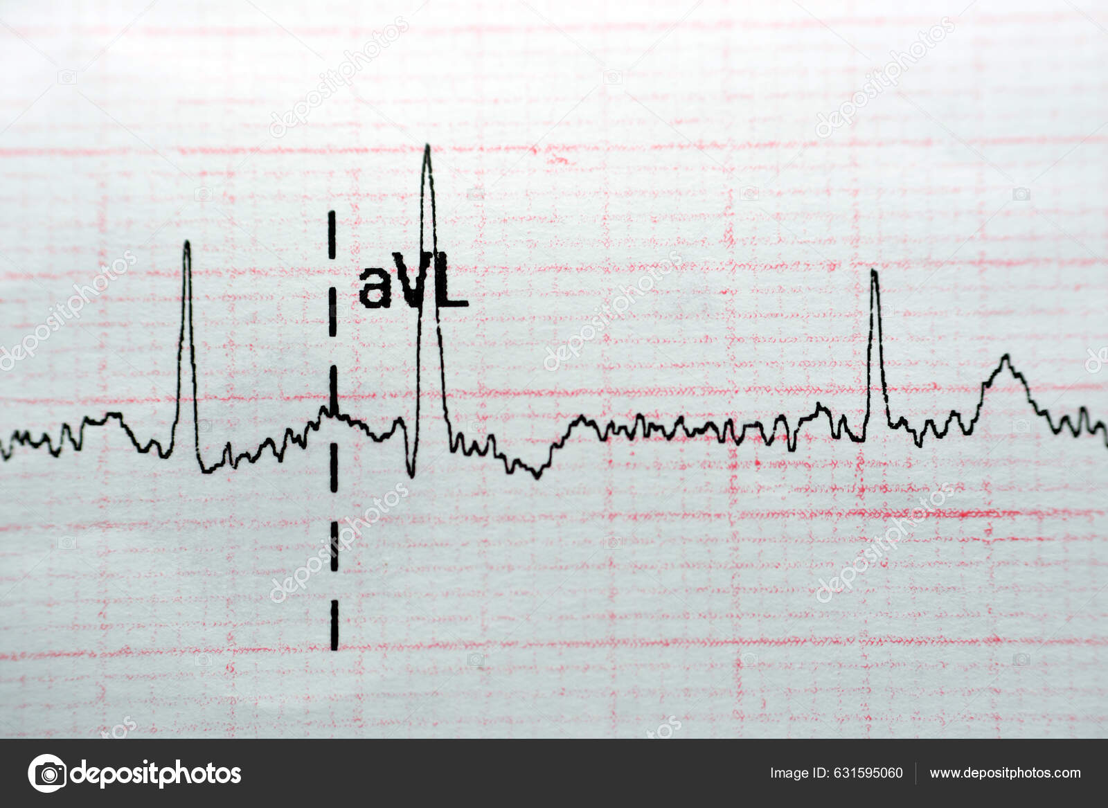Ecg Electrocardiograph Paper Shows Normal Sinus Rhythm Nsr Frequent Pacs Stock Photo by ©Tamer