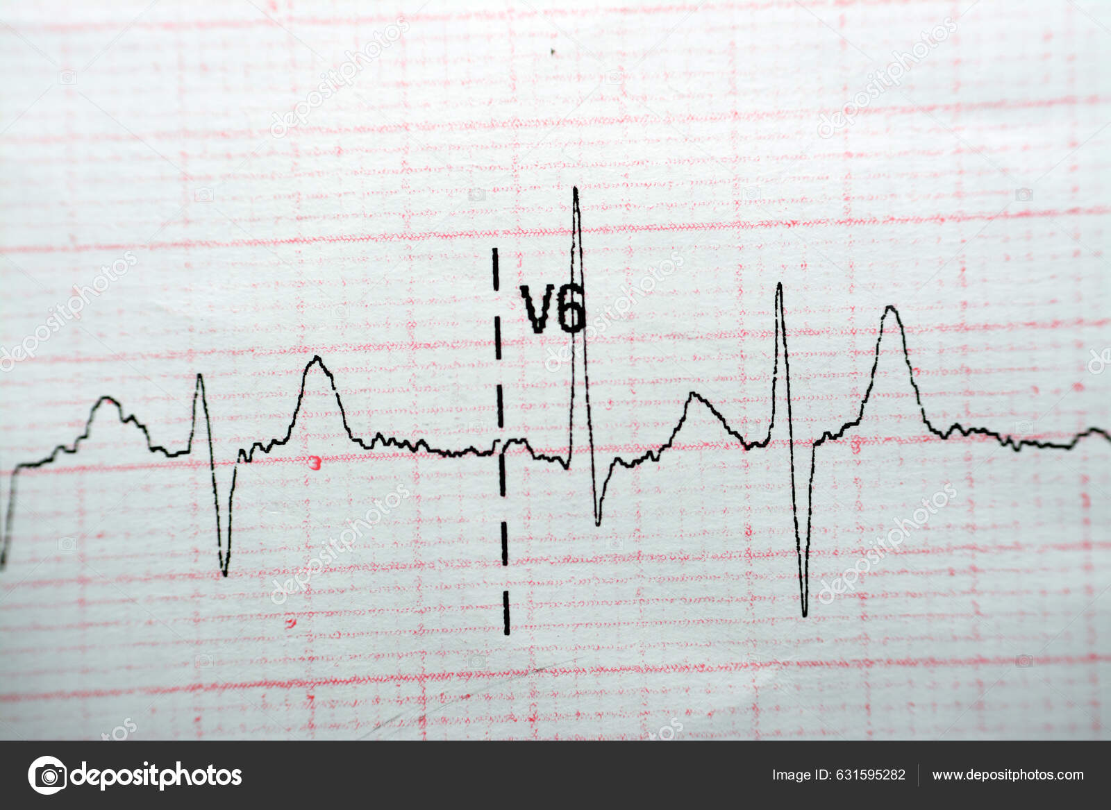 Ecg Electrocardiograph Paper Shows Normal Sinus Rhythm Nsr Frequent Pacs fotografía de stock