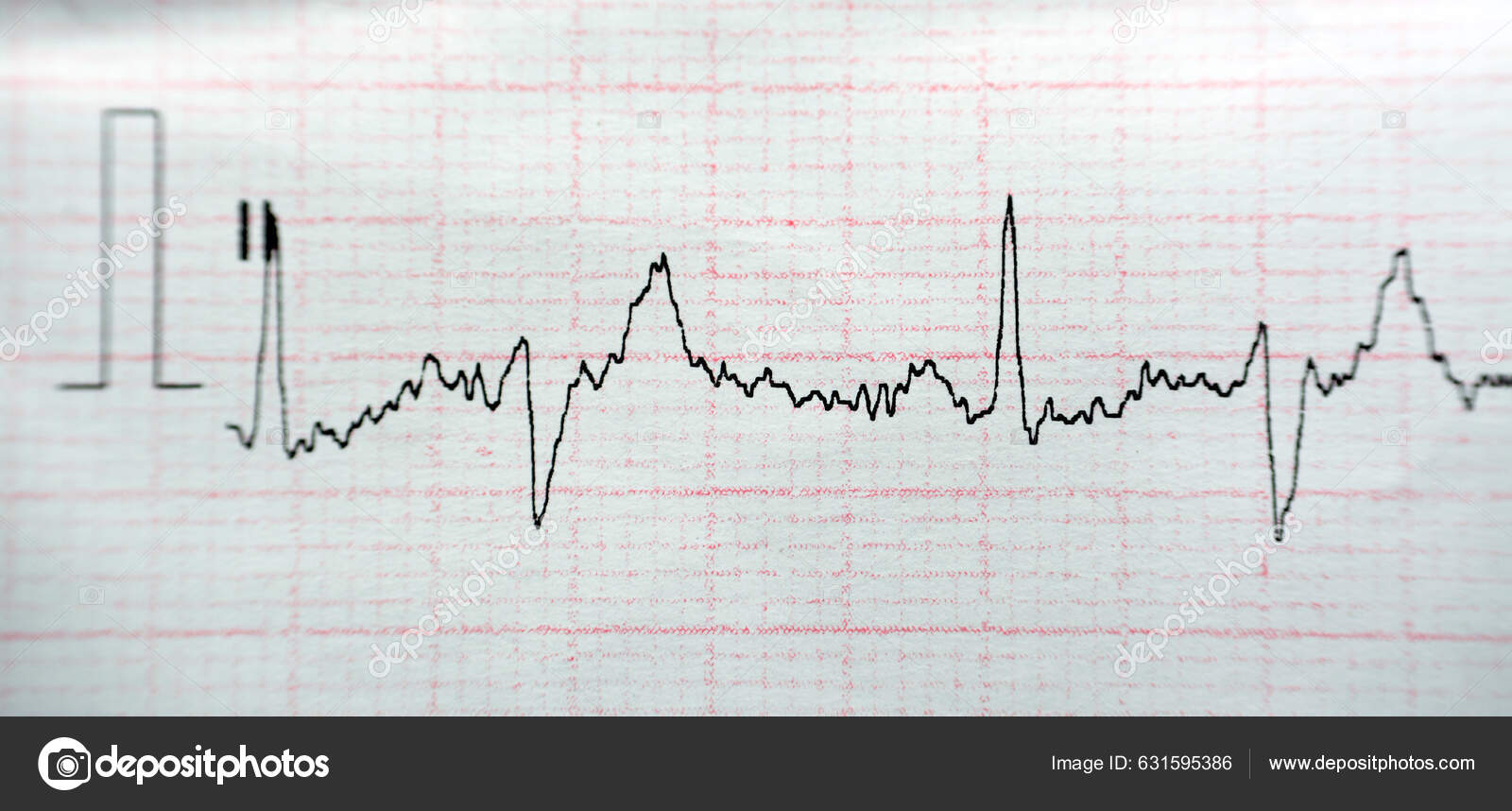 Ecg Electrocardiograph Paper Shows Normal Sinus Rhythm Nsr Frequent Pacs Stock Photo by ©Tamer