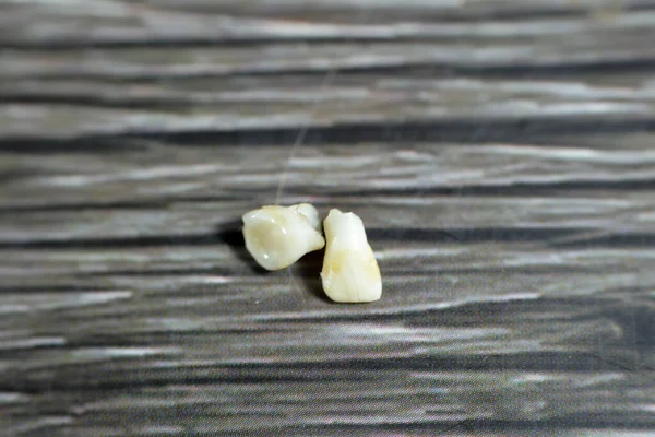 Dentes Decíduos Decíduos Leite Primário Temporários Primeiro Conjunto Dentes Crescimento — Fotografia de Stock