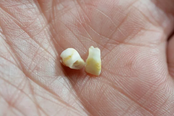Vtrã Primã Baby Tillfälliga Tänder Den Rsta Uppsã Ttningen Tänder — Stockfoto
