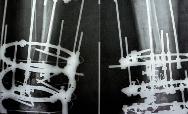 Distal parçalı kırık fibula plaka ve vidalar tarafından yönetiliyor, distal kaval kemiği dış halka sabitleyicisi ILIZAROV çerçeve sklertoik kemik rezeksiyonu ve proksimal kortikotomi ve segment transferi ile yönetiliyor.