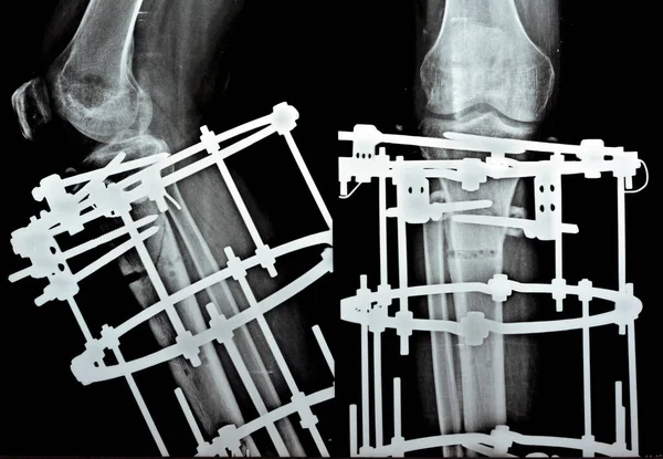 远端粉碎性骨折腓骨由钢板和螺钉管理 远端胫骨由外环固定器Ilizarov框架管理 硬骨切除 近端皮质切除 节段转移 — 图库照片