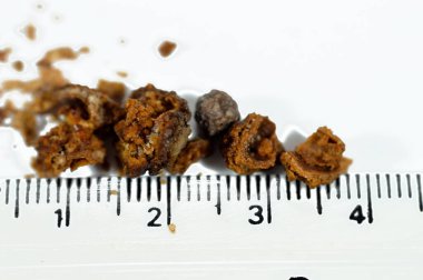 Nephrolithiasis, düzensiz kahverengi böbrek taşları (renal calculus veya nephrolith), ameliyat üreteroskopisi ve Laser Lithotripsi ve parçalanma sonrası taşların boyutları farklıdır, seçici odaklanma