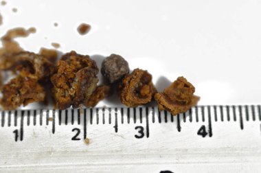 Nephrolithiasis, düzensiz kahverengi böbrek taşları (renal calculus veya nephrolith), ameliyat üreteroskopisi ve Laser Lithotripsi ve parçalanma sonrası taşların boyutları farklıdır, seçici odaklanma