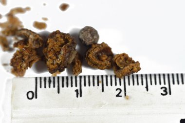 Nephrolithiasis, düzensiz kahverengi böbrek taşları (renal calculus veya nephrolith), ameliyat üreteroskopisi ve Laser Lithotripsi ve parçalanma sonrası taşların boyutları farklıdır, seçici odaklanma