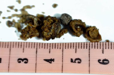 Nephrolithiasis, düzensiz kahverengi böbrek taşları (renal calculus veya nephrolith), ameliyat üreteroskopisi ve Laser Lithotripsi ve parçalanma sonrası taşların boyutları farklıdır, seçici odaklanma