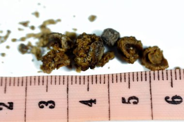 Nephrolithiasis, düzensiz kahverengi böbrek taşları (renal calculus veya nephrolith), ameliyat üreteroskopisi ve Laser Lithotripsi ve parçalanma sonrası taşların boyutları farklıdır, seçici odaklanma