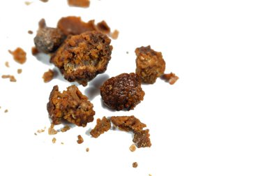 Nephrolithiasis, düzensiz kahverengi böbrek taşları (renal calculus veya nephrolith), ameliyat üreteroskopisi ve Laser Lithotripsi ve parçalanma sonrası taşların boyutları farklıdır, seçici odaklanma