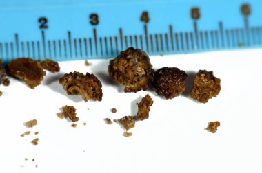 Nephrolithiasis, düzensiz kahverengi böbrek taşları (renal calculus veya nephrolith), ameliyat üreteroskopisi ve Laser Lithotripsi ve parçalanma sonrası taşların boyutları farklıdır, seçici odaklanma