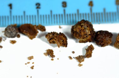 Nephrolithiasis, irregular brown kidney stones (renal calculus or nephrolith), the stones are different in size after operative ureteroscopy and Laser Lithotripsy and fragmentation, selective focus clipart