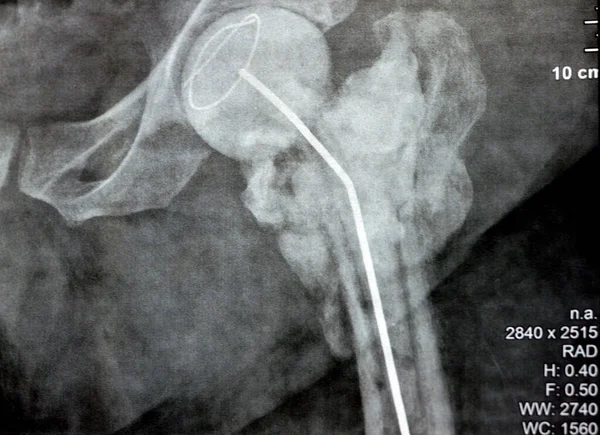 Articulação Radiológica Simples Quadril Mostra Fratura Cervical Trans Esquerda Cabeça — Fotografia de Stock