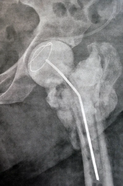 Einfache Röntgenaufnahme Des Hüftgelenks Zeigt Linke Trans Zervikale Fraktur Des — Stockfoto