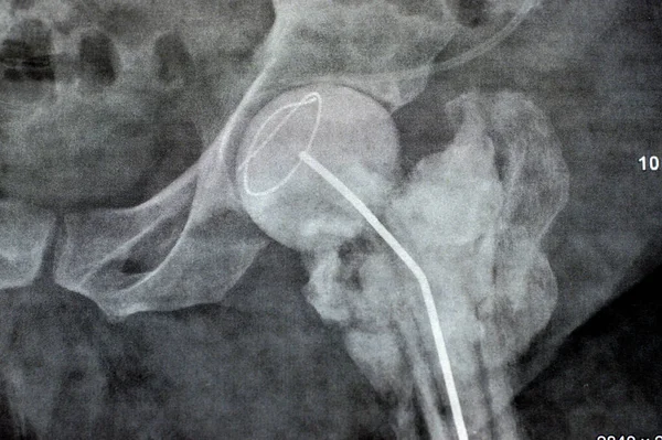 Articulación Simple Cadera Rayos Muestran Fractura Cervical Trans Izquierda Cabeza —  Fotos de Stock